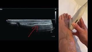 Ultrasound Sonoanatomy - Identifying Bones of the Foot (Dorsal)