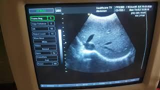 Ultrasound medison 8000live test full probe