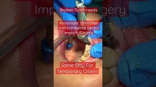 Broken Tooth, Extraction, Dental Implant Surgery, Temporary Crown