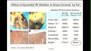 Epicardial VT Abalation: Tips and Traps