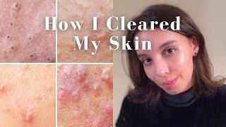 How I got rid of Acne ONCE AND FOR ALL! (Pharmacist journey)