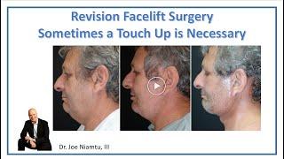 Revision Facelift Surgery:  Sometimes You Need a Touch Up  #deepplanefacelift #revisionfacelift