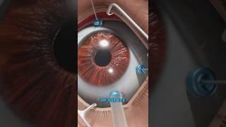 What is a vitrectomy? (3D Animation)