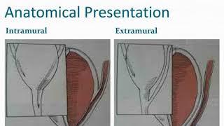 ectopic ureters