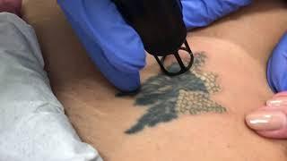 Laser Tattoo Removal