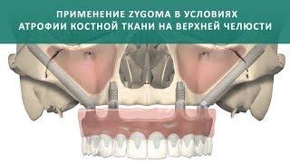 Скуловая имплантация Зигома (Nobel Zygoma)