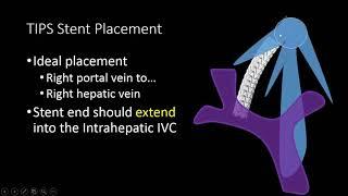 TIPS Stent US Doppler Evaluation