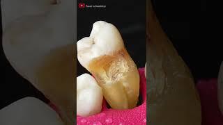 Hidden Tooth Cavity #asmr #dentist