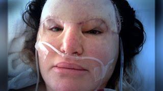 Cosmetic Injections Disfigured My Face!