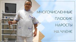  Многочисленные плоские наросты на члене. Клинический случай №95