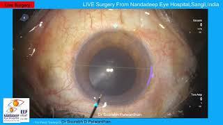 Black Cataract Dr Sourabh D Patwardhan live Phaco surgery.