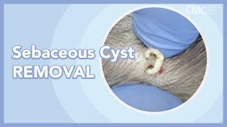 Sebaceous Cyst Removal