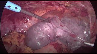 Laparoscopic management of second trimester uterine rupture.