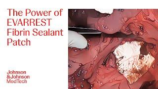 Bleeding Management in Vena Cava Injury Using EVARREST Fibrin Sealant Patch | Ethicon