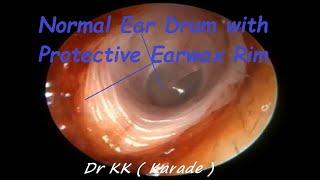 Normal Ear Drum with Protective Earwax Rim