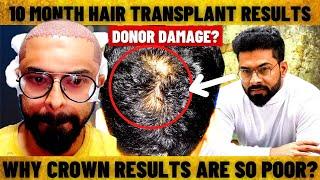Donor Damage at HSN Bangalore? | HSN Hair Transplant Results | #ameerht #hairtransplant #tamilanht