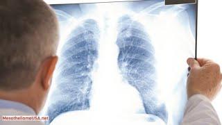 5 Year Survival Mesothelioma - What is Survival Rates of Mesothelioma?