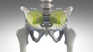 Sacroiliac Joint Fusion with the iFuse Implant System