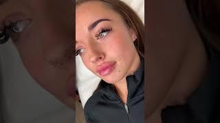 Russian lips before and after #shorts // tiktok chichesteraesthetics