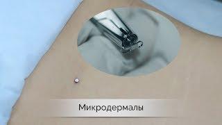 Микродермал – установка | пирсинг Самара влог | microdermal piercing