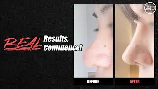 Real Results, Confidence! Part 3 | AB Plastic Surgery Korea