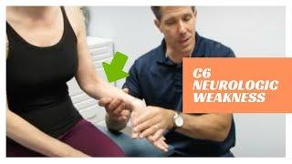 C6 Neurologic Weakness Post Nerve Root Decompression