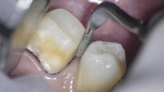 prosthetics preparation of a lower molar