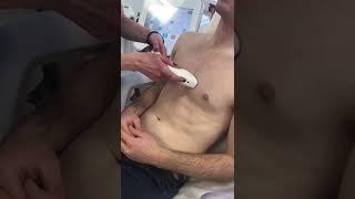 MALE CHEST LASER HAIR REMOVAL