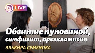 Предлежание плаценты, обвитие пуповиной, преэклампсия. Акушер-гинеколог и врач УЗД Эльвира Семенова