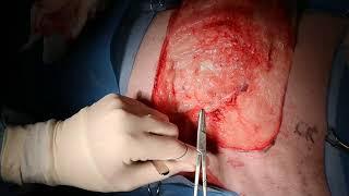 Large soft tissue sarcoma removal from the flank of a dog