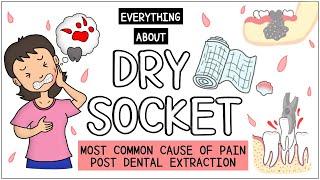 Dry Socket (After tooth extraction): All you need to know