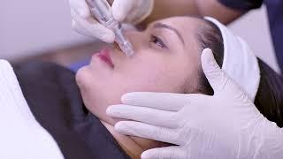 Stem cell for acne scars and open pores