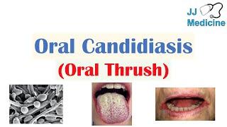 Oral Candidiasis (Oral Thrush) | Causes, Pathophysiology, Signs & Symptoms, Diagnosis, Treatment