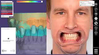 INSIGHTS 2018  DentalCAD Case Demonstration   Bridge with attachments and partial Part I