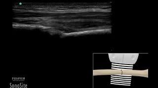 How To: Pathology Long Bone Fracture 3D Video