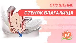 ​ Опущение стенок влагалища