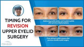 Safe Timing of Revision Blepharoplasty #hoodedeyes