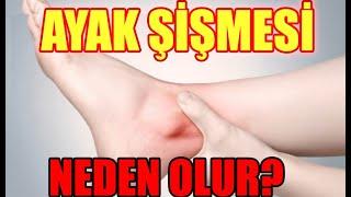 AYAK ŞİŞMESİ NEDEN OLUR? AYAK ŞİŞMESİ NASIL GEÇER?