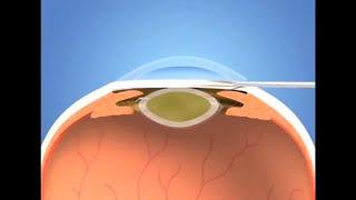 Микрохирургия глаз - Глазная клиника Доктора Быкова #докторбыков #хирургияглаза