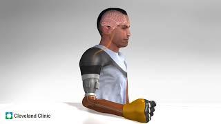 Prosthetic Function Advances with First Demonstration of Illusory Movement Perception in Amputees