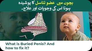 What is Burried or Hidden penis in children? | Its Reason and treatment | Hindi and Urdu