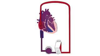 Recirculation on VV ECMO