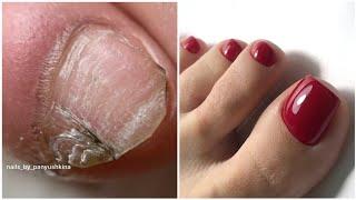 Most Satisfying Pedicure Transformation  best nail polish for toes 2024