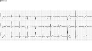 How to diagnose unfamiliar ECG patterns in A&E? - An Example of Concept Based Approach to ECGs