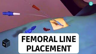 Central Line placement (Femoral Vein): Medical animation