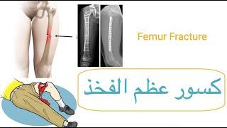 Femur Fracture / كسر عظم الفخذ: أسبابه، أعراضه، وعلاجه | معلومات طبية مهمة