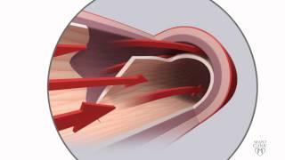 Spontaneous coronary artery dissection (SCAD) Animation