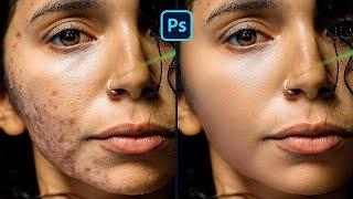 ACNE REMOVAL  Photoshop Tutorial