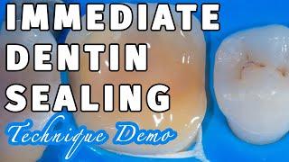 Biomimetic Dentistry- Immediate Dentin Sealing with Self-Etch DBA