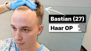 Bastian macht Schluss mit Geheimratsecken - Haartransplantation | Erfahrung